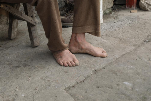 七旬老人长年只有一双鞋 光脚在田里干活在重庆市北碚区的金刀峡镇胜