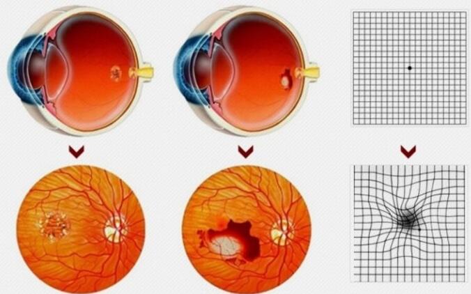 老年黄斑变性的症状有哪些?如何治疗?