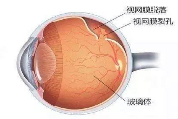 视网膜脱落与近视手术有关系